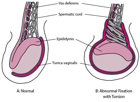 testicular torsion genitourinary disorders msd manual professional edition