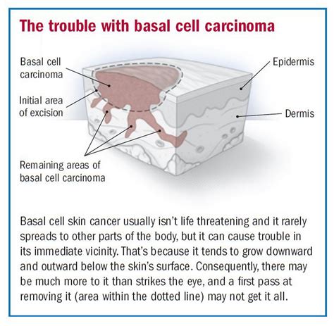 Basal Cell Skin Cancer Diagram