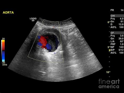 Aortic Aneurysm Ultrasound Images Aortic Aneurysm Describes An Aorta
