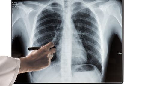 Costochondritis Causes Symptoms And Treatment