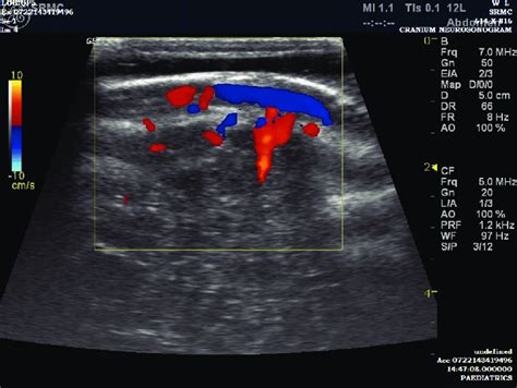 Ultrasound Sonography Showing Subaponeurotic Fluid Collection In Case 2