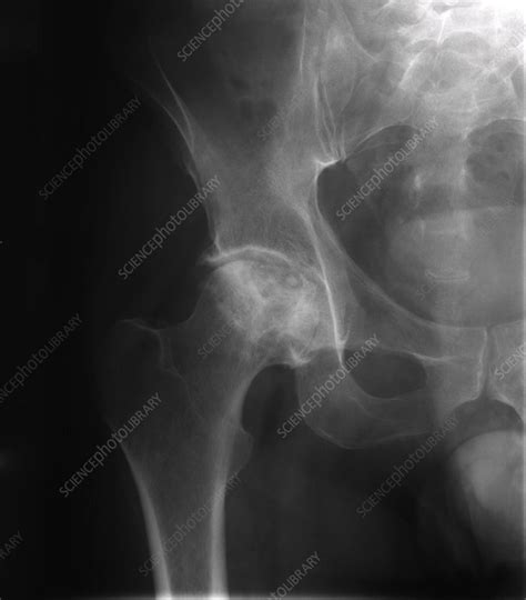 X Ray Of Arthritic Hip Stock Image M1100648 Science Photo Library