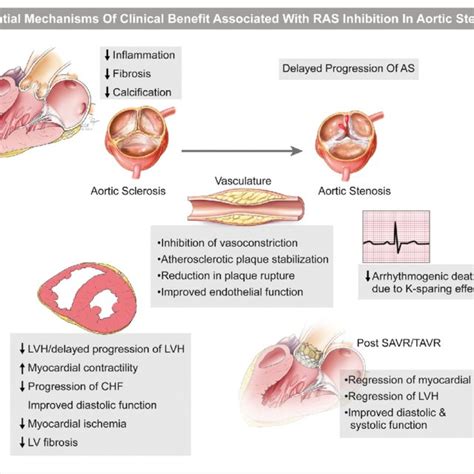 Pathophysiology Of Aortic Stenosis And Potential Steps Where Ras Hot