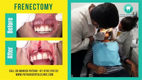 Frenectomy By Dr Manish Pathak At Pathak Dental Clinic Pimpri