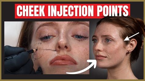 The Best Cheek Filler Injection Points Where To Inject The Cheek For