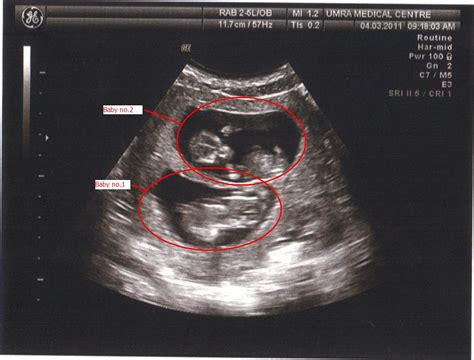 Baru mengetahui bahwa bunda hamil dengan usia kandungan 4 minggu? My Pregnancy Day and Progress...: Gambar scan babies...