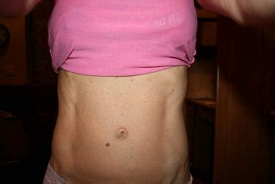 Access hollywood, la times, star, la mag, us mag, elle, cnbc, intouch Downtime for Umbilical Hernia Repair, and How Bad is Scar? (photo) Doctor Answers, Tips