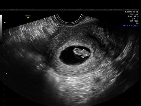 7 Weeks And 5 Days Pregnant Ultrasound Pictures Picturemeta