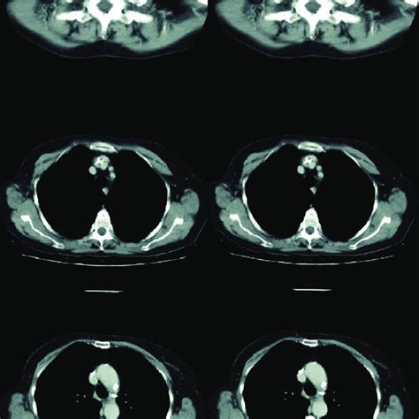 Computed Tomography Ct Imaging Showing More Than A Year Of Complete