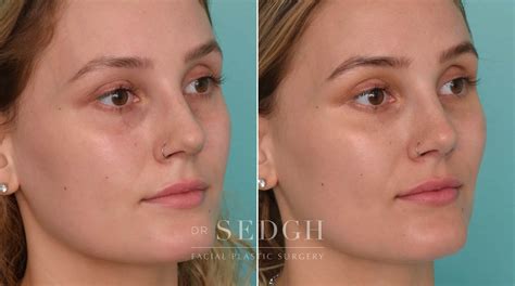 Tear Trough Filler Before And After Photos Dr Jacob Sedgh