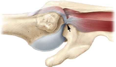 Figure 14 From Mri Of Impingement Syndromes Of The Shoulder Semantic