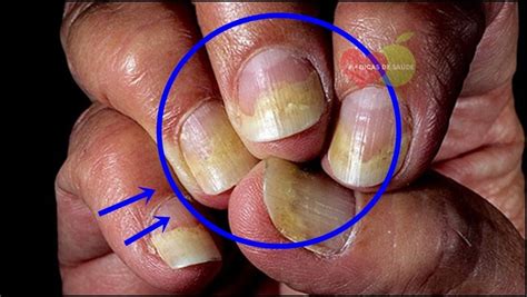 Como tratar a psoríase de forma natural. Os 5 Tratamentos Naturais Para Psoríase nas Unhas | Dicas ...
