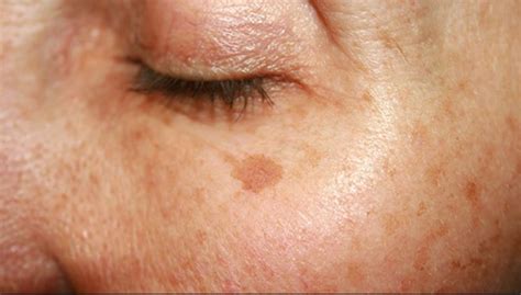 Age Spots On Face Causes And Ways To Fade Them Skincarederm