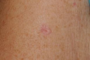 Basal cell carcinoma, if neglected or inappropriately managed can give rise to significant morbidity and even death. Skin Cancer Photos | Mohs Surgery Patient Education