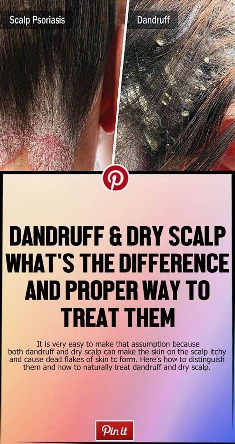 It Is Very Easy To Make That Assumption Because Both Dandruff And Dry