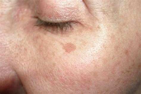 Hyperpigmentation Age Spots Eucerin