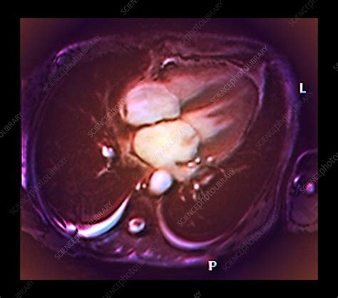 Cardiac Mitral Valve Leak Mri Scan Stock Image C0337383 Science