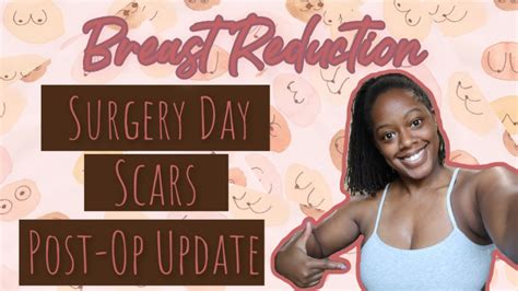 Breast Reduction Journey Surgery Day Scars Post Op Update Youtube