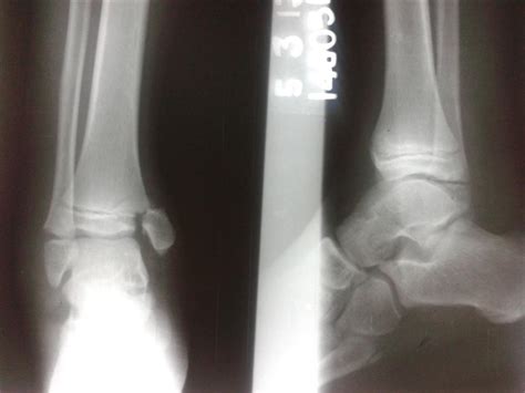 Ankle Fractures Pediatric Pediatrics Orthobullets