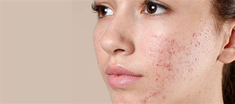 How To Take Care Of Oily Skin And Acne Reequil