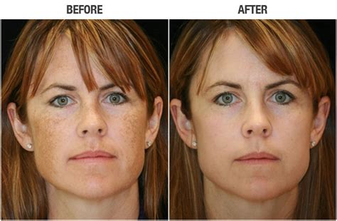 Ipl Photofacial And Skin Rejuvenation Dark Spot Removal