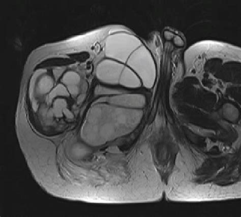 Mri Image Demonstrating The Multiple Multiloculated Cystic Lesions And
