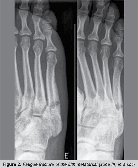 Surgical Management Of Proximal Fifth Metatarsal Fractures Porn Sex Picture