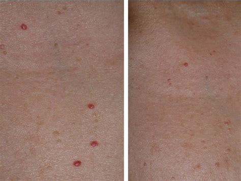 Although cherry angiomas won't go away on their own, a professional skin specialist can recommend safe and effective cherry angioma removal using a vascular laser, which uses laser/light energy to heat the blood vessels to a temperature that will break them down. Cherry Angiomas Laser Treatment | Lafayette, LA | Renewed Med Spa