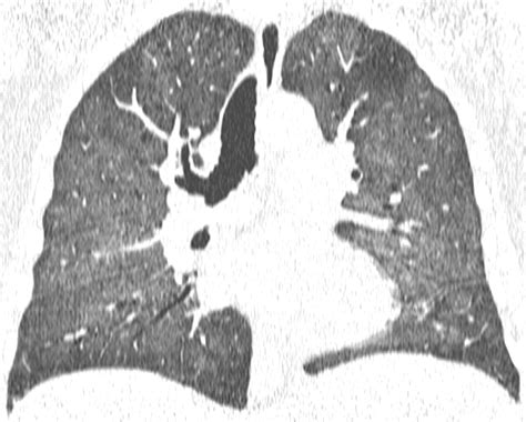 Pneumocystis Jiroveci Pneumonia High Resolution Ct Findings In