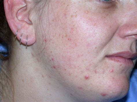 Blackhead vs. Pimple: What's the Difference?