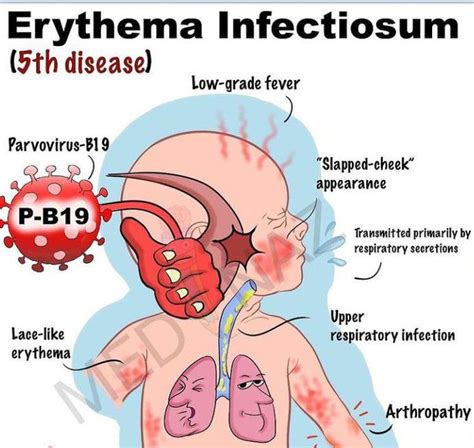 Erythema Infectiosum Visual Mnemonic MEDizzy