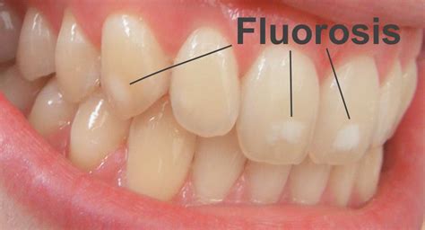 All About White Lines On Teeth Fluorosis And Craze Lines