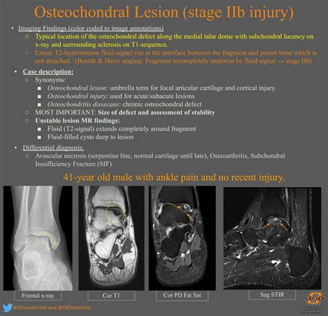 Osteochondral Lesion Of The Talus Msk Radiology Imaging Grepmed