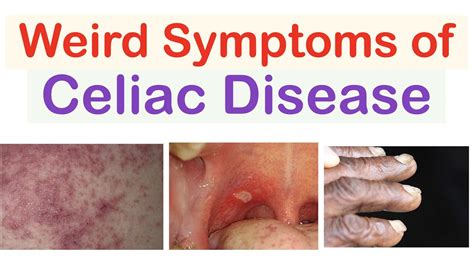 Weird Symptoms Of Celiac Disease Atypical Clinical Features Youtube