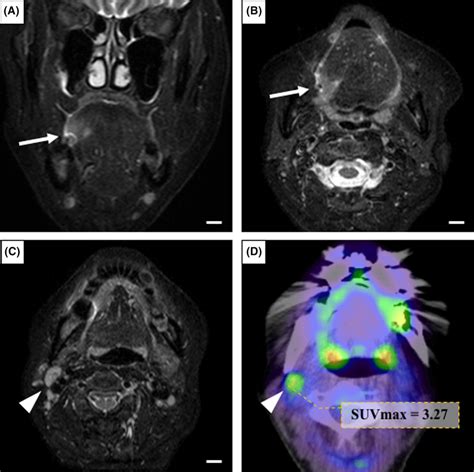 A B Axial A And Coronal B Fat‐suppressed T2‐weighted Mr Image