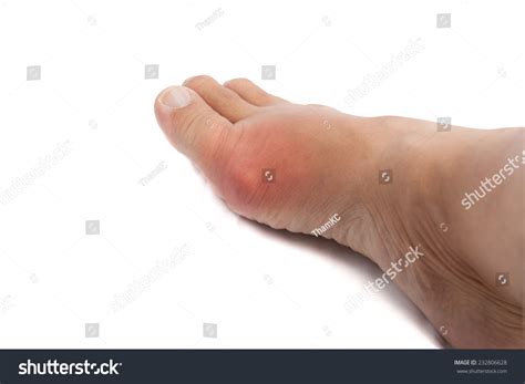 Painful Gout Inflammation On Big Toe Stock Photo 232806628 Shutterstock