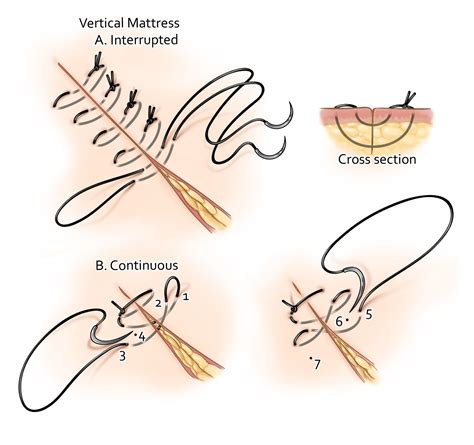 Suturing And Closure The Neurosurgical Atlas