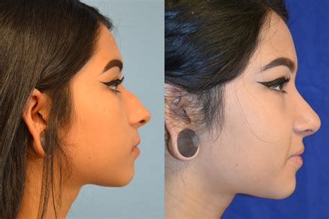 Nose Surgery Before And After Photos Patient 161 San Francisco Ca