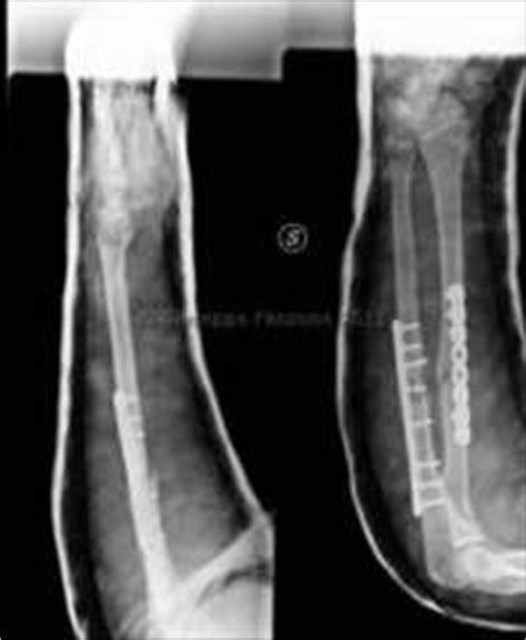 Frattura di radio ed ulna - Dr. G. Fanzone