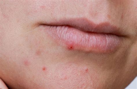 Cold Sore Vs Lip Pimple Whats The Difference Cleveland Clinic
