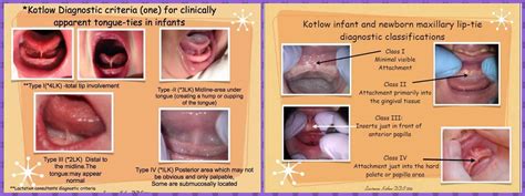 Lip Tie In Infants What You Should Know The Early Weeks