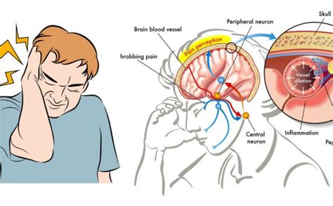 Petua mudah hilangkan cirit birit diperingkat permulaan. Petua Hilangkan Sakit Kepala Disebabkan Migrain Dengan 2 ...