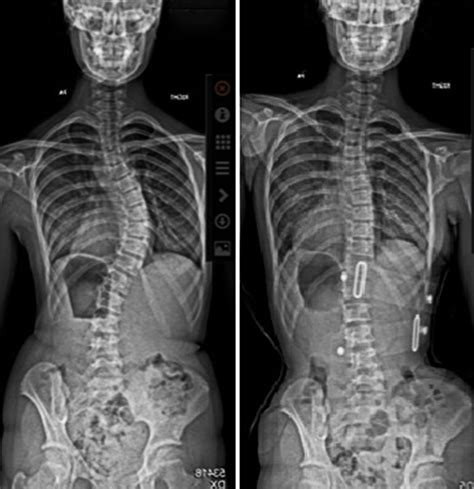 Scoliosis Treatment Costs