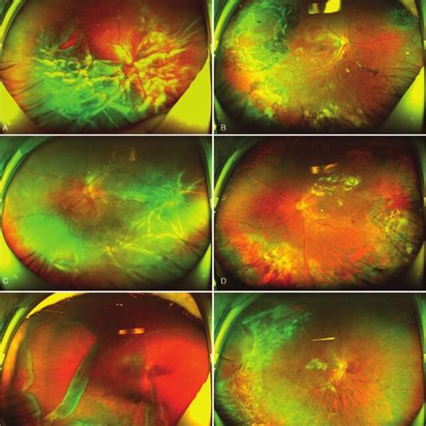 Representative Fundus Images Of 3 Patients With Complicated Rd