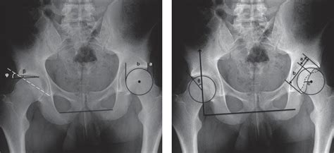 A Right Hip The Acetabular Index Is The Angle β Between The Line