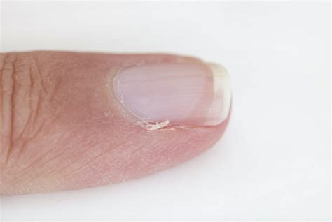 Sintetiza más de imágenes sobre como curar los padrastros de las uñas recién actualizado