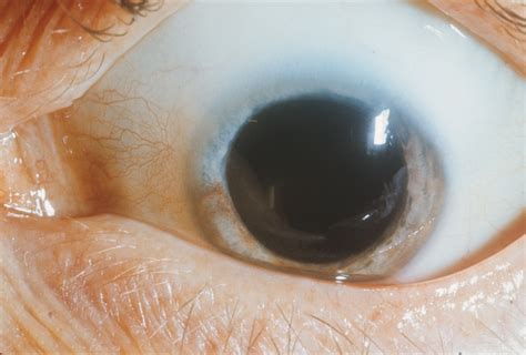 Waardenburg Syndrome Type 1 Hereditary Ocular Diseases