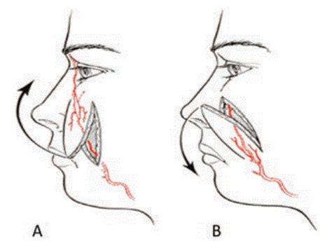 Reconstruction Of Nasal Subunits Using A Nasolabial Flap Case Report