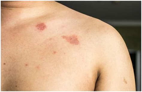 Nummular Eczema Vs Ringworm Symptoms Causes Treatment