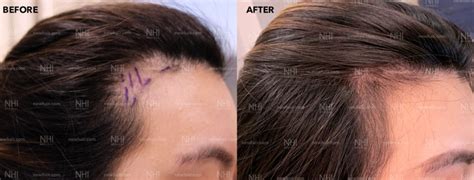 Nhi Medical Hairline Lowering Surgery New Hair New You